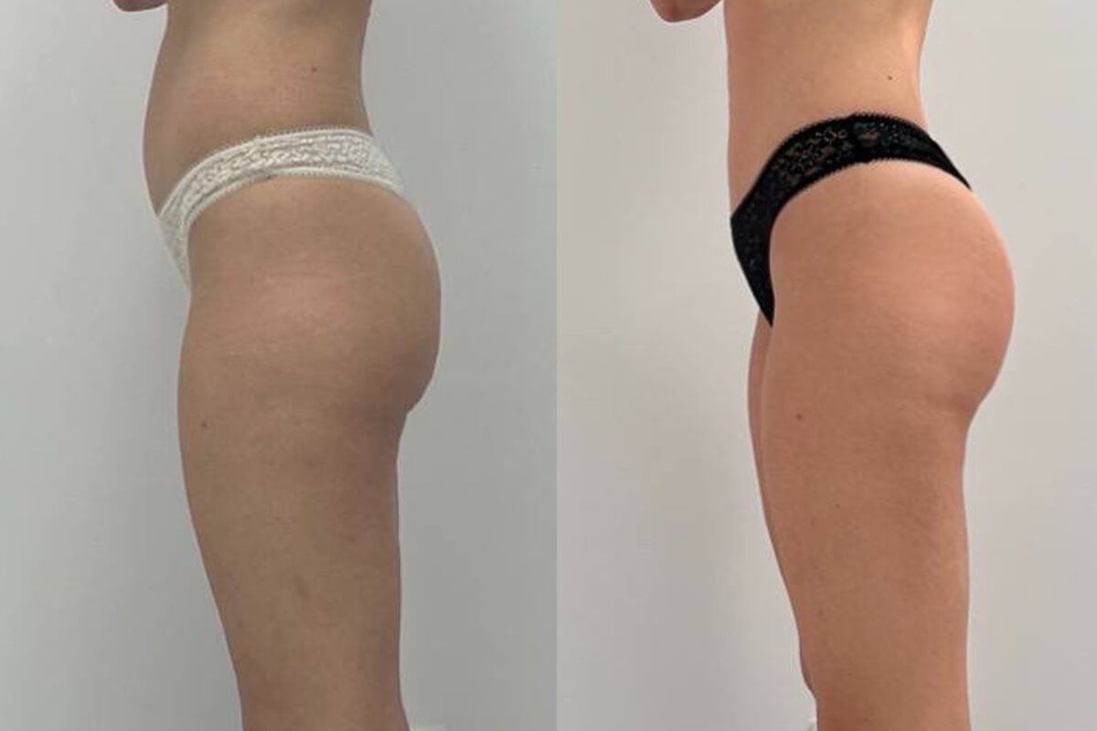 Аппарат EVOLVE 01