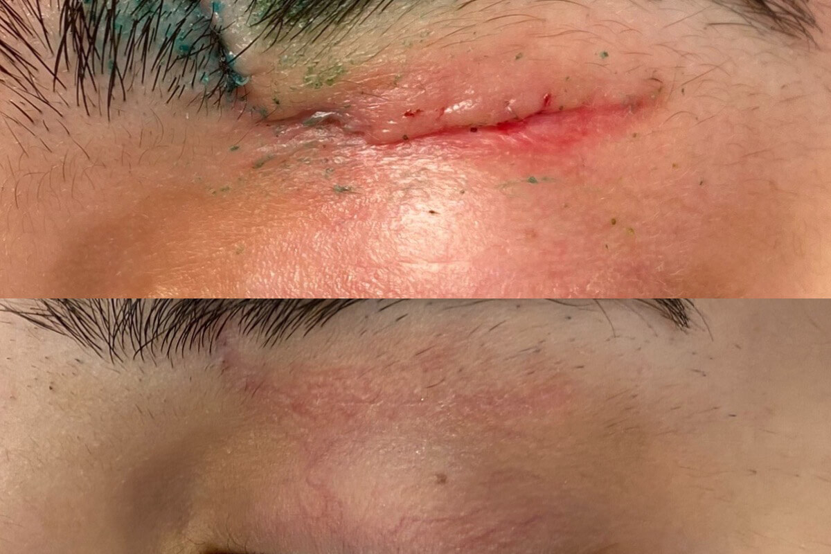 Хирургическое иссечение рубца 01