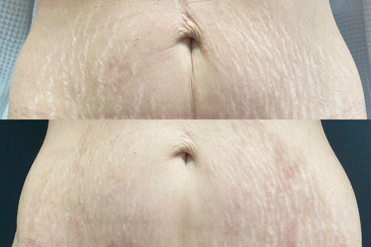 Хирургическое иссечение рубца 01