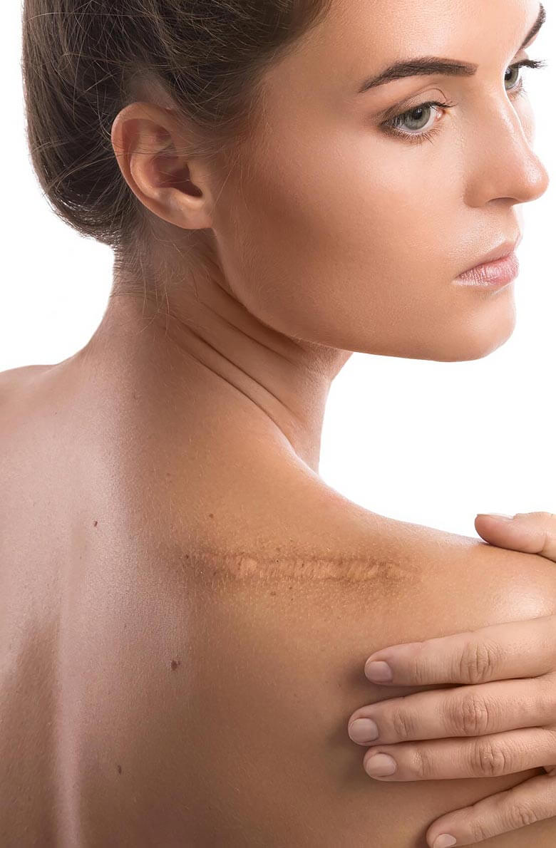 khirurgicheskoe-issechenie-rubtsa-2