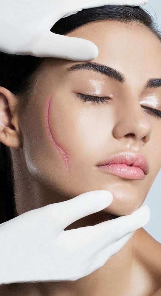 Коррекция рубцов на аппарате PicoSure