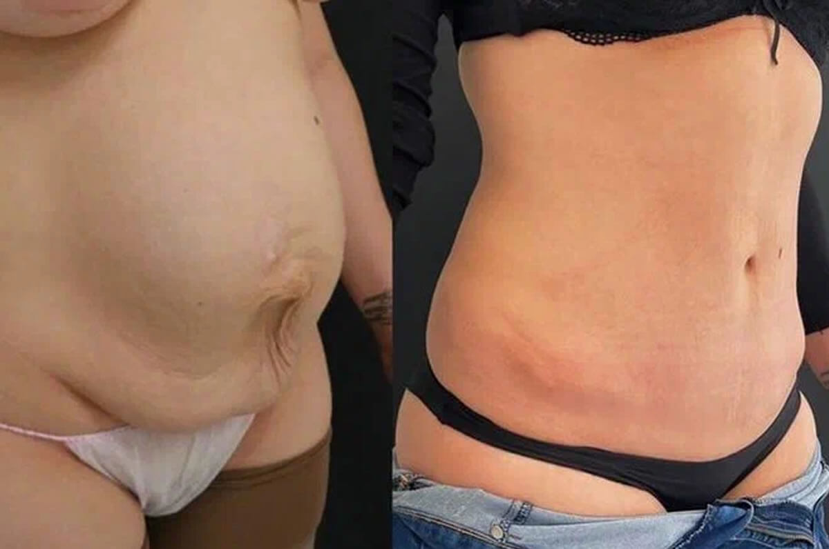 Абдоминопластика с липосакцией 01