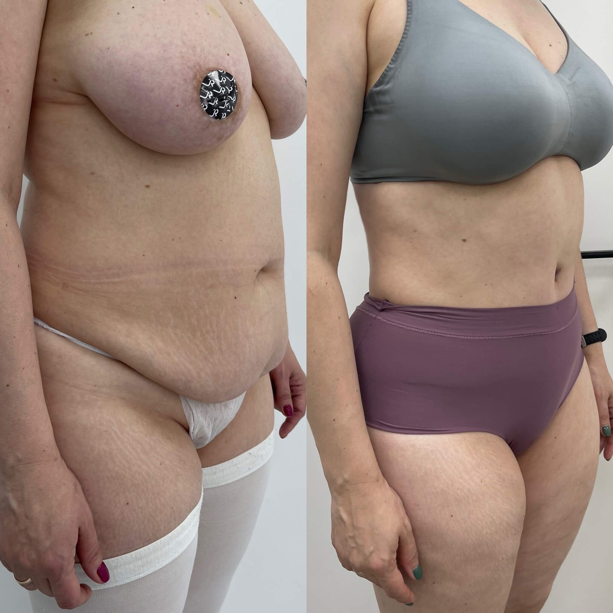 Абдоминопластика с липосакцией 01