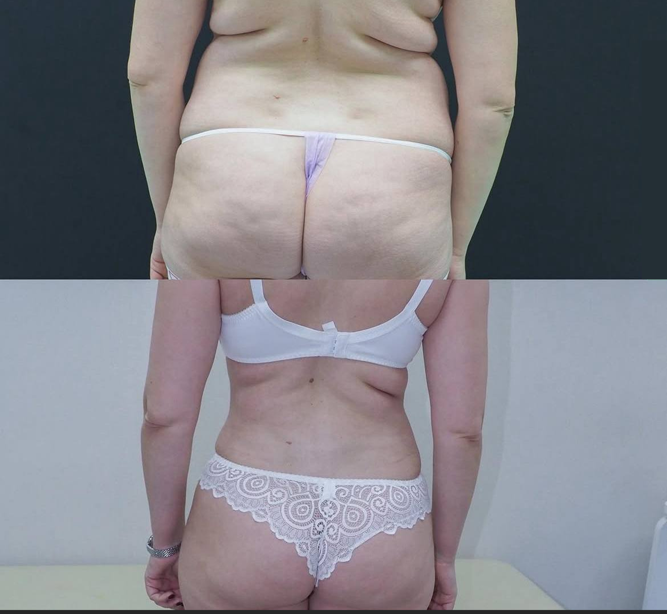 Абдоминопластика с липосакцией 01