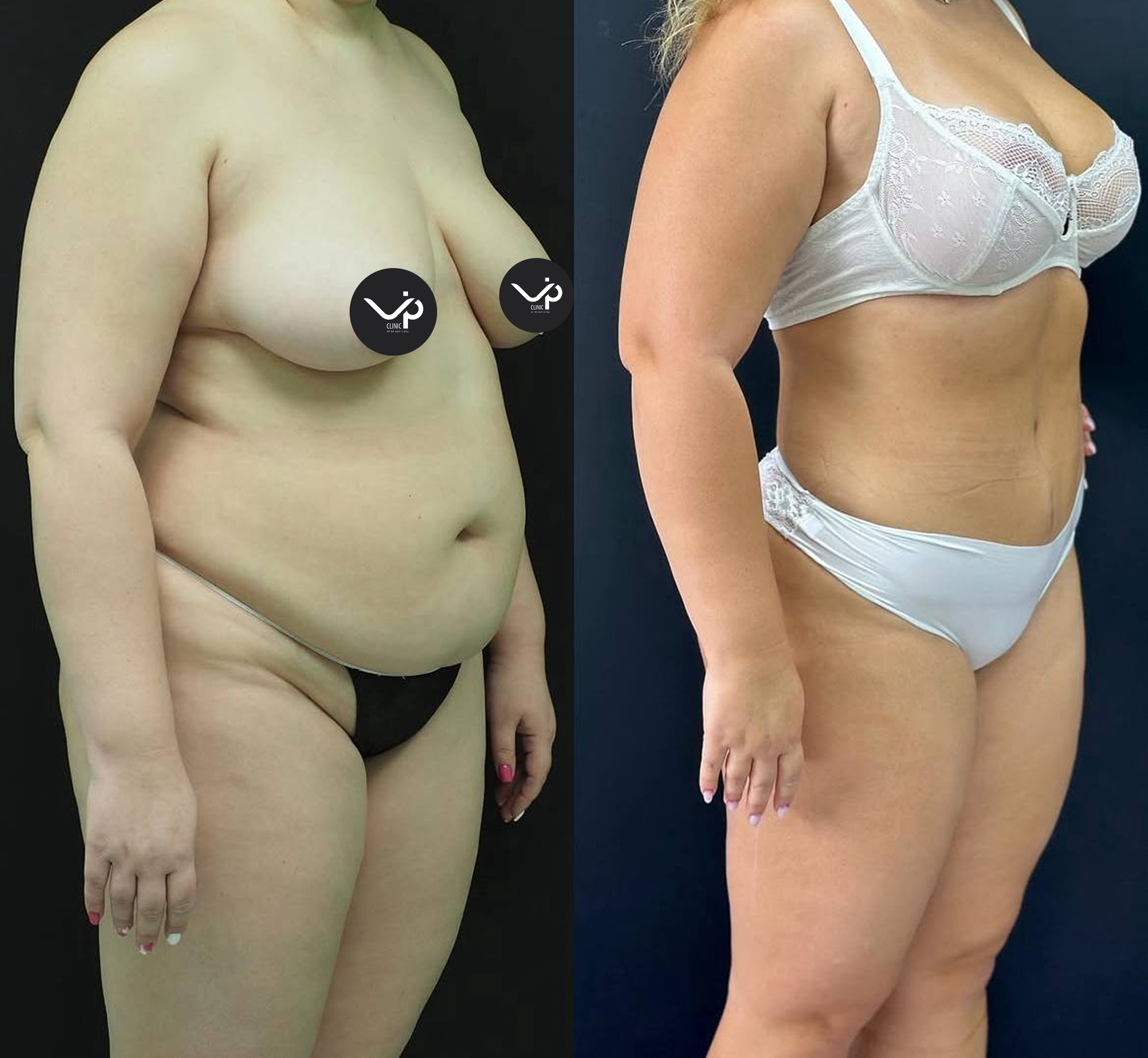 Абдоминопластика с липосакцией 01