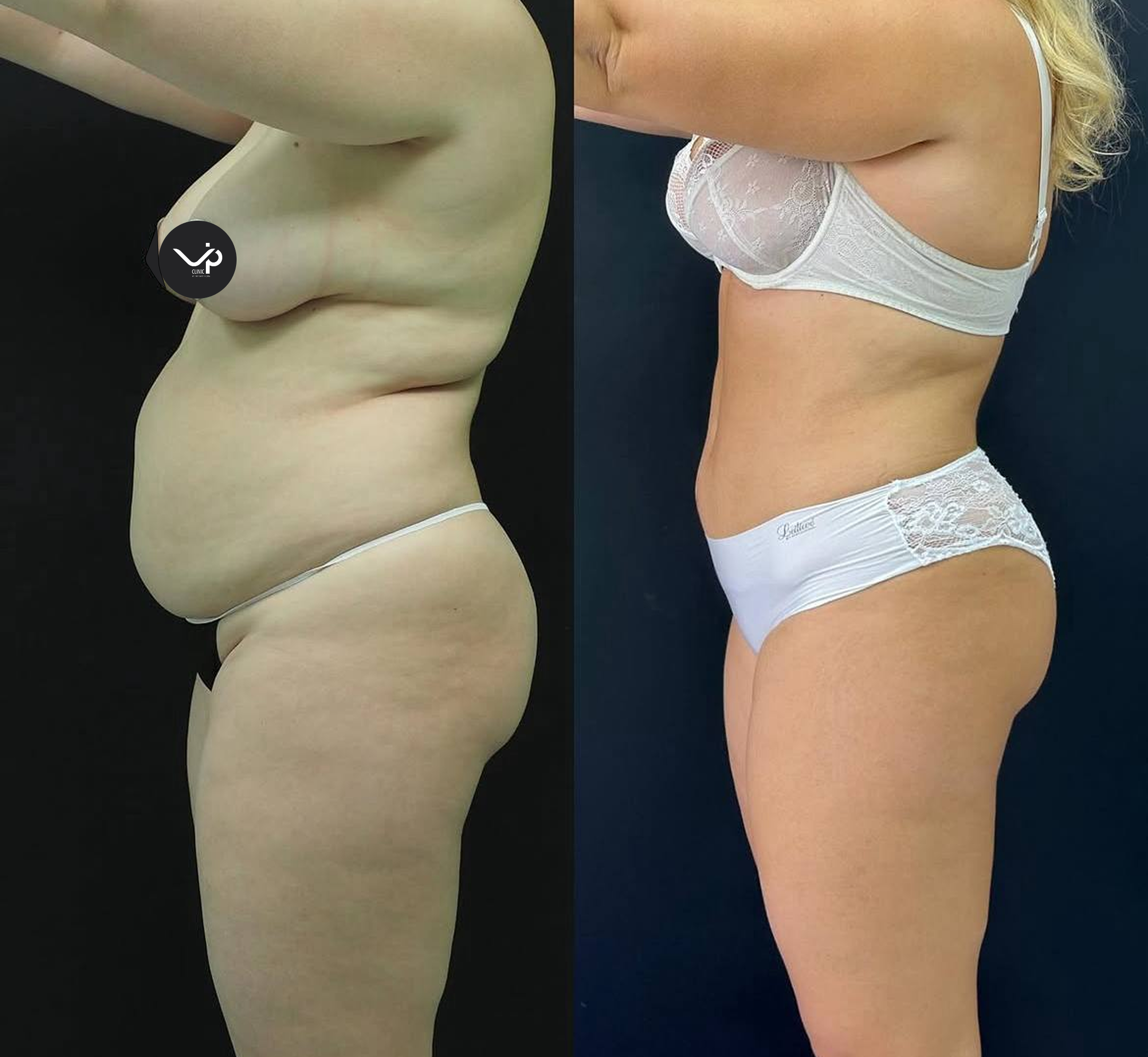 Абдоминопластика с липосакцией 01