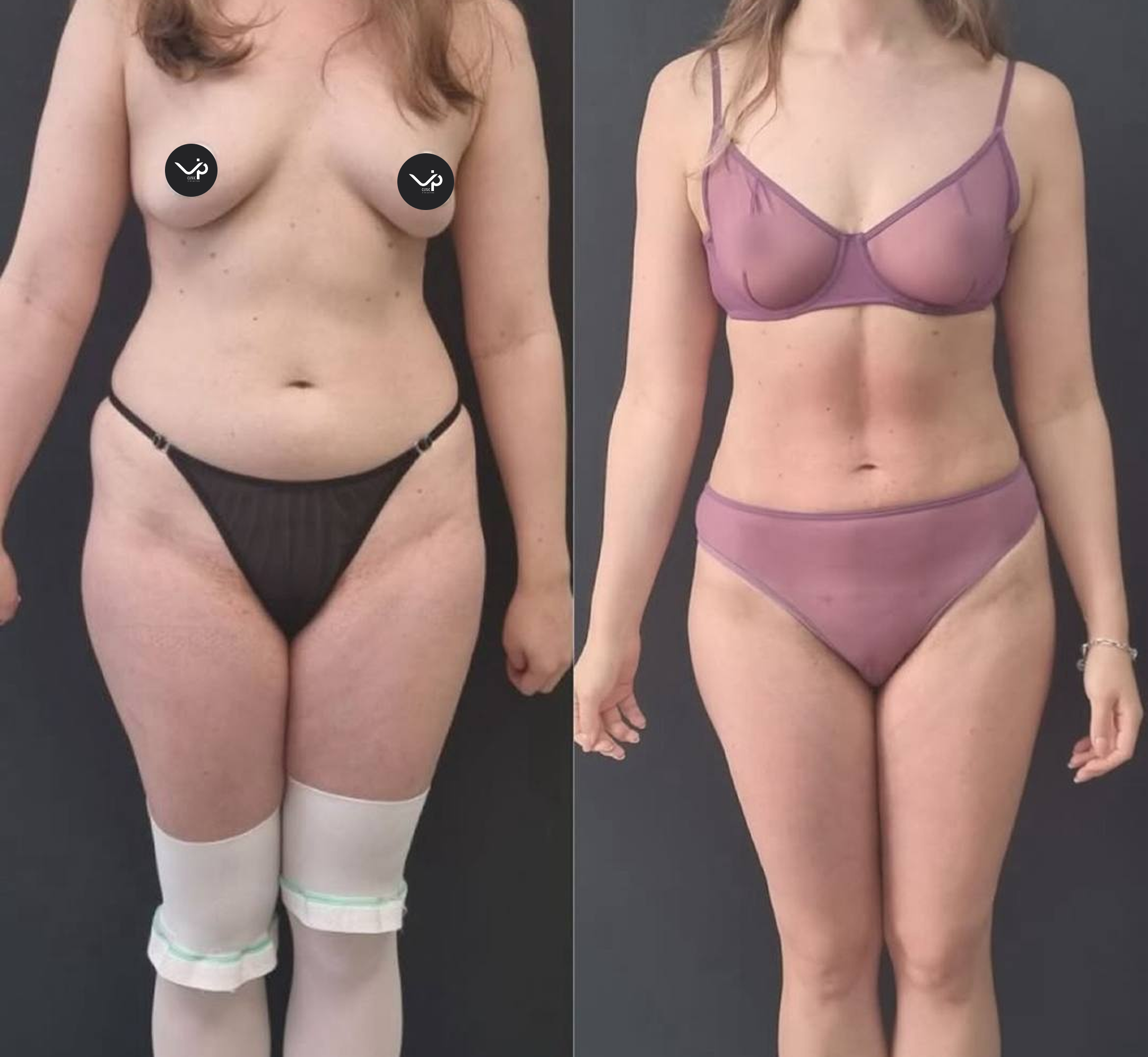 Абдоминопластика с липосакцией 01