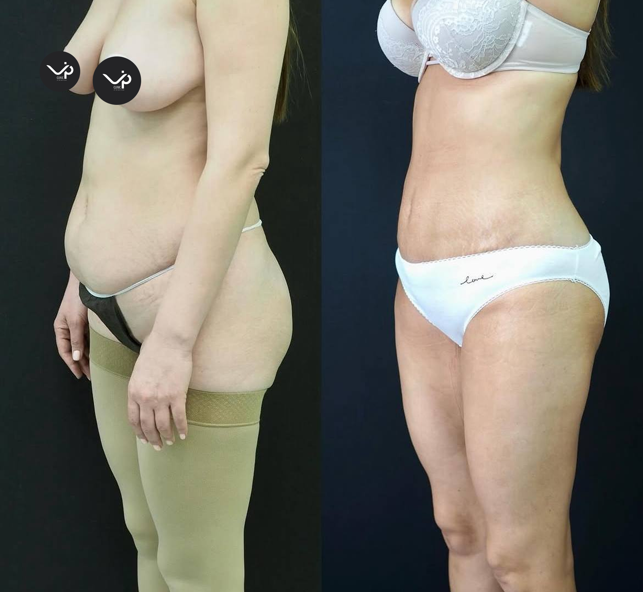 Абдоминопластика с липосакцией 01