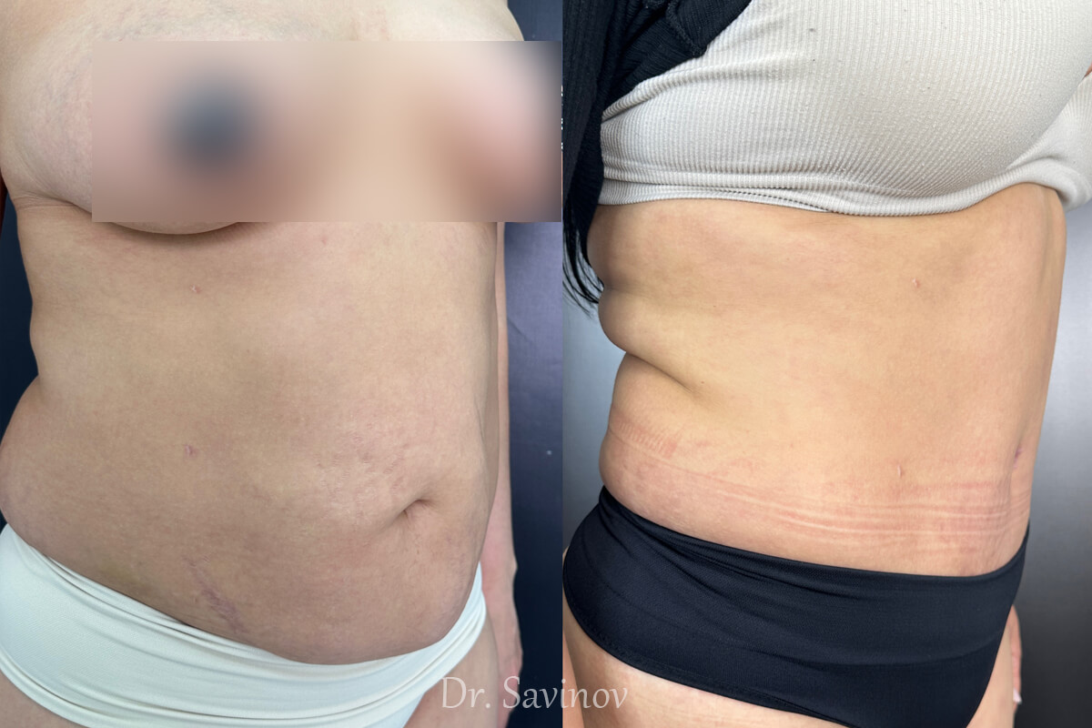 Ушивание диастаза 01