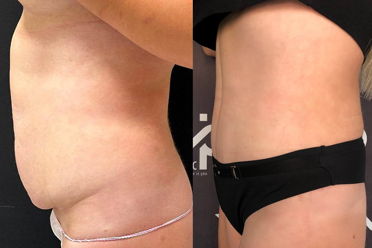 Ушивание диастаза 01