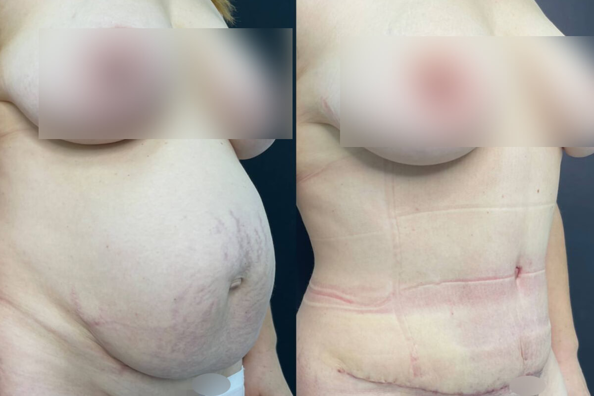 Абдоминопластика с липосакцией 01