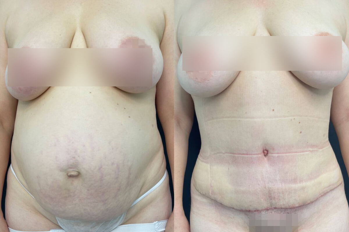 Абдоминопластика с липосакцией 01