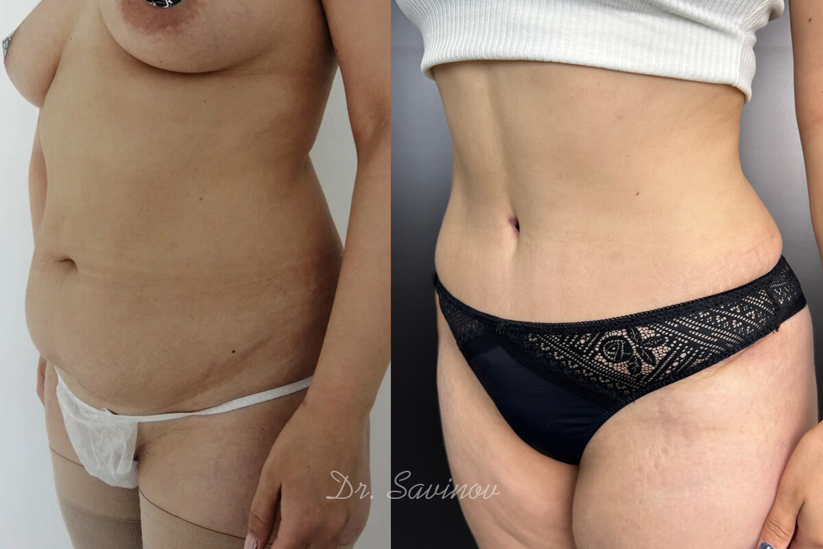 Ушивание диастаза 01