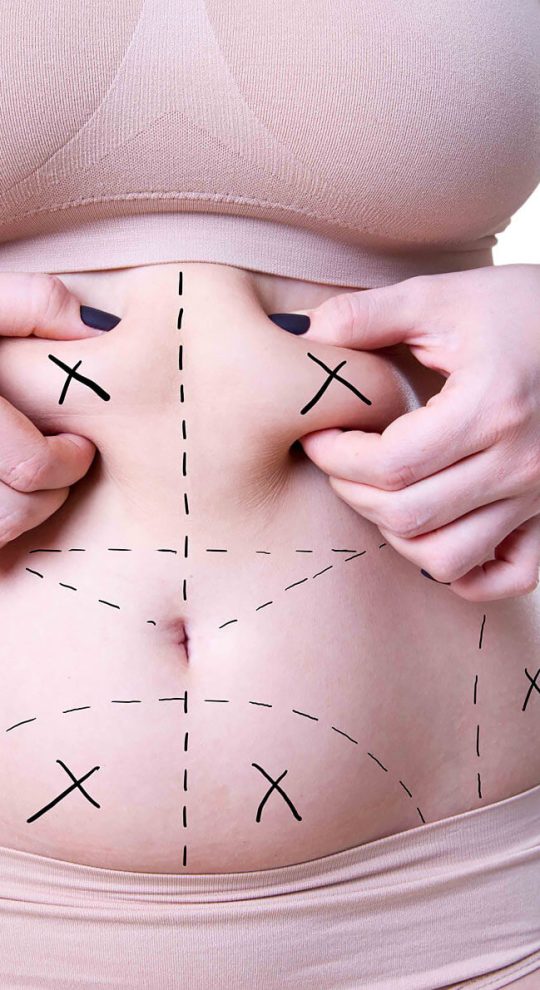 Абдоминопластика с липосакцией