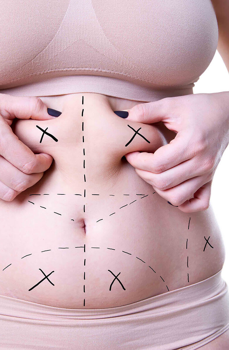 Абдоминопластика с липосакцией