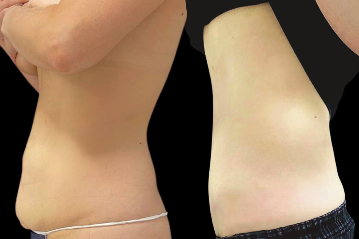 Ушивание диастаза 01