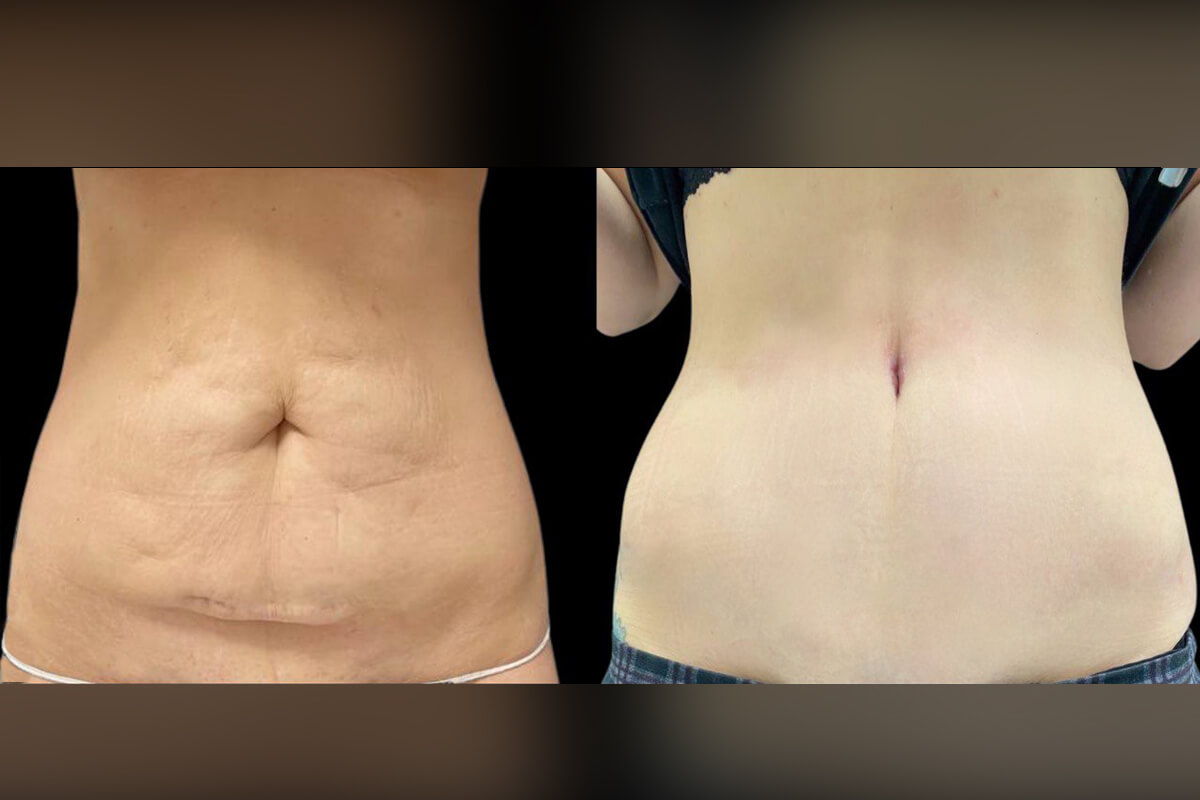 Ушивание диастаза 01