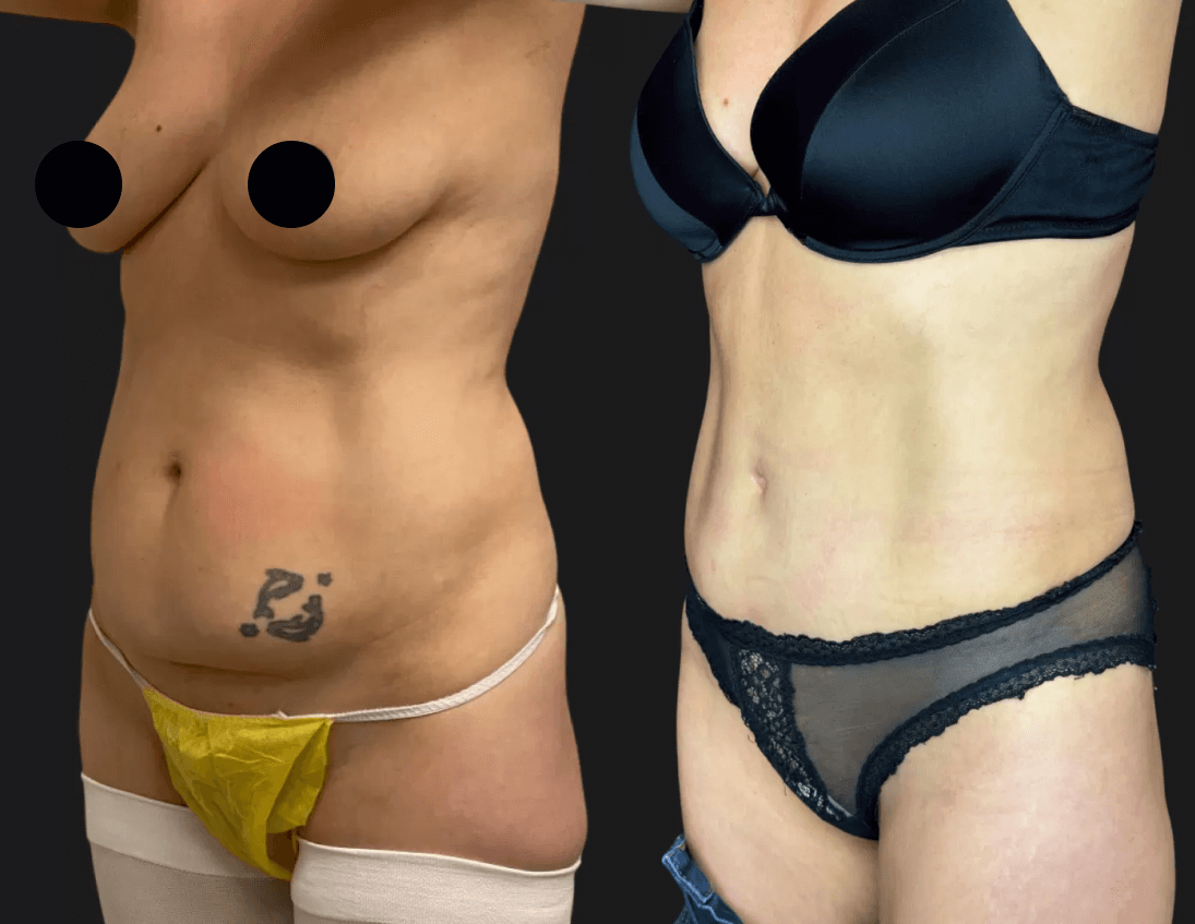 Абдоминопластика с липосакцией 01