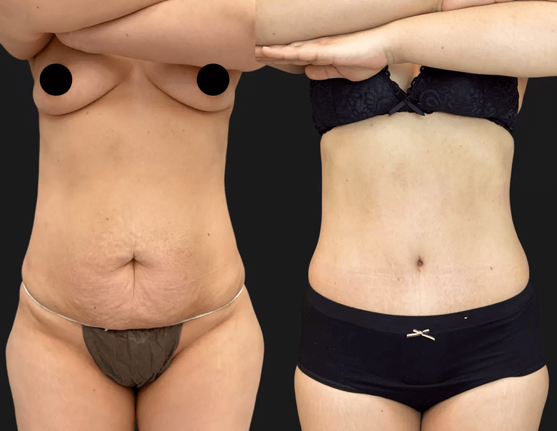 Абдоминопластика с липосакцией 01