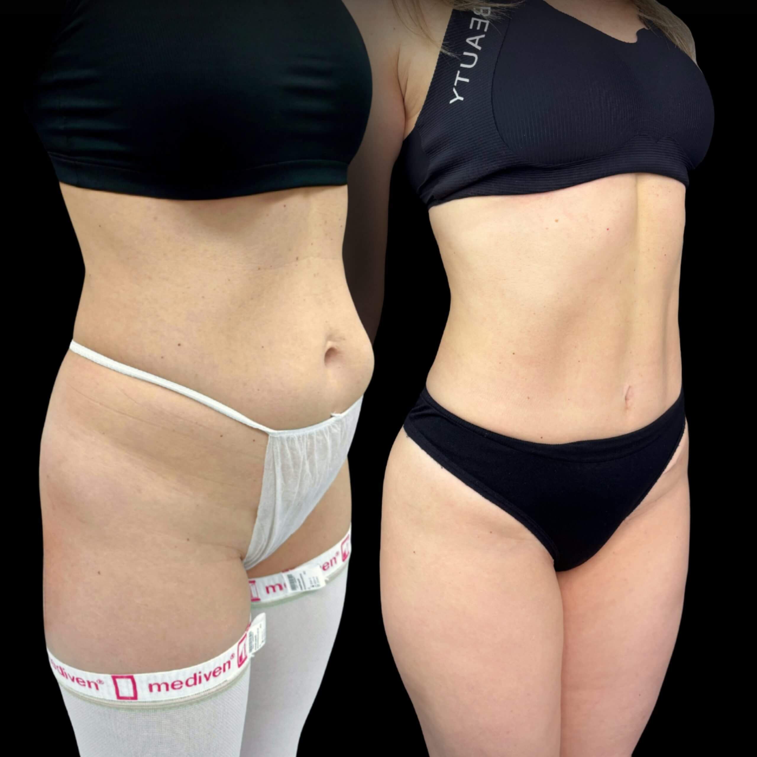 Абдоминопластика с липосакцией 01