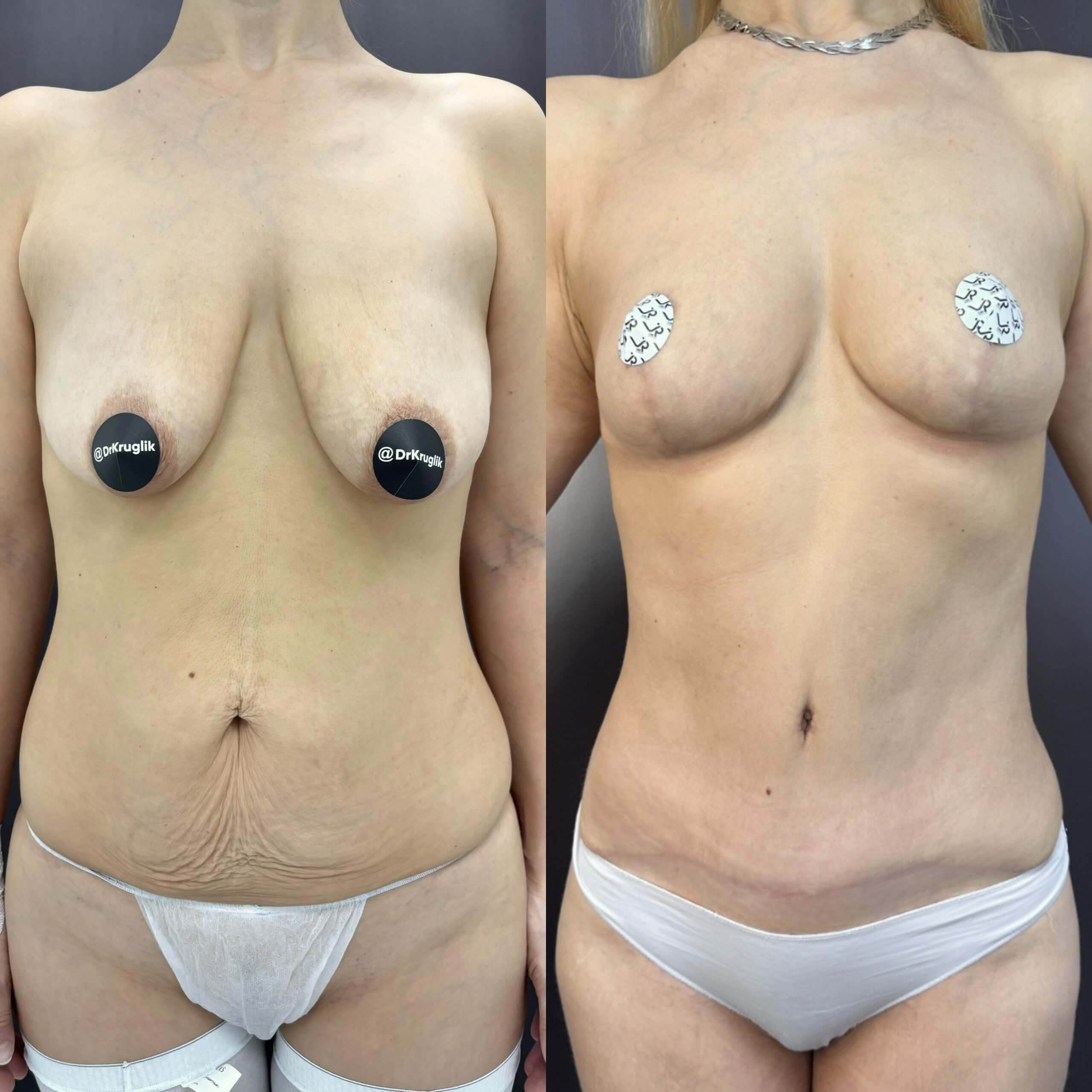 Абдоминопластика с липосакцией 01