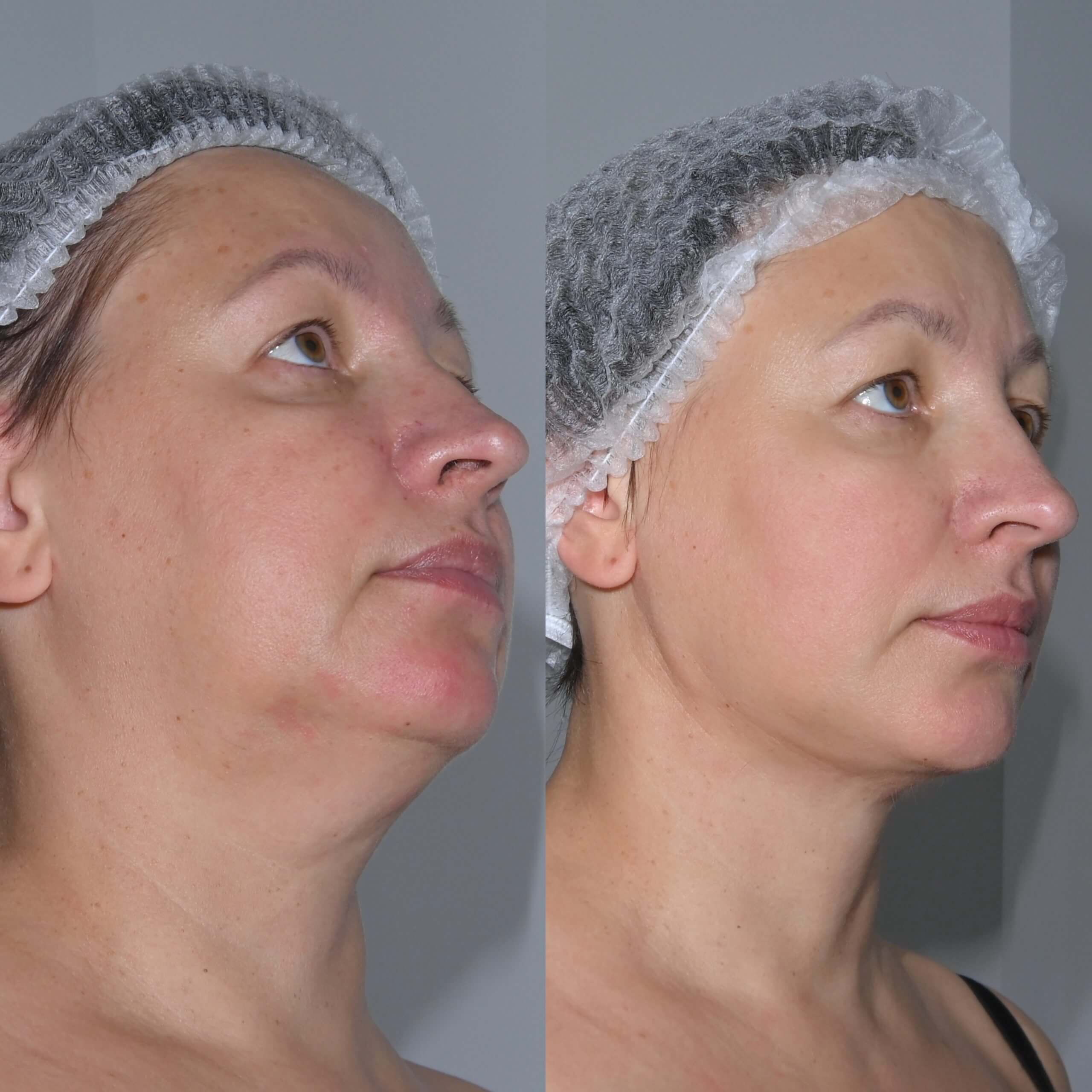 Нитевой лифтинг лица 01