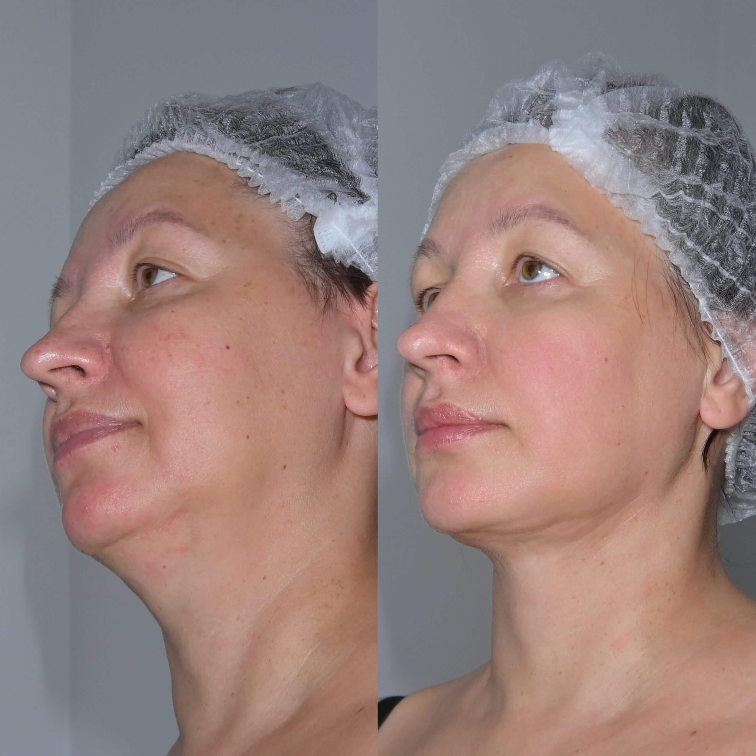 Липосакция подбородка и шеи 01