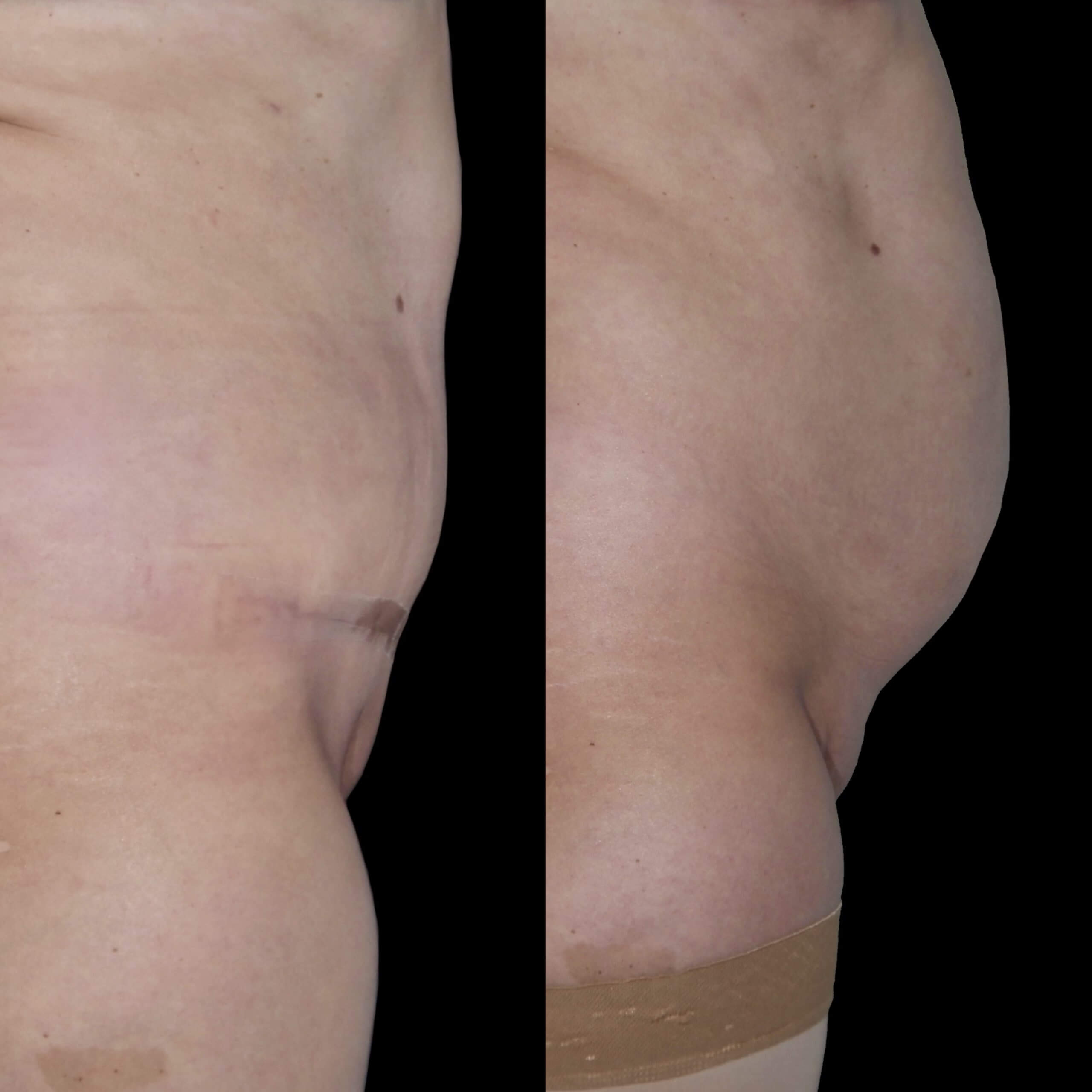 Абдоминопластика с липосакцией 01
