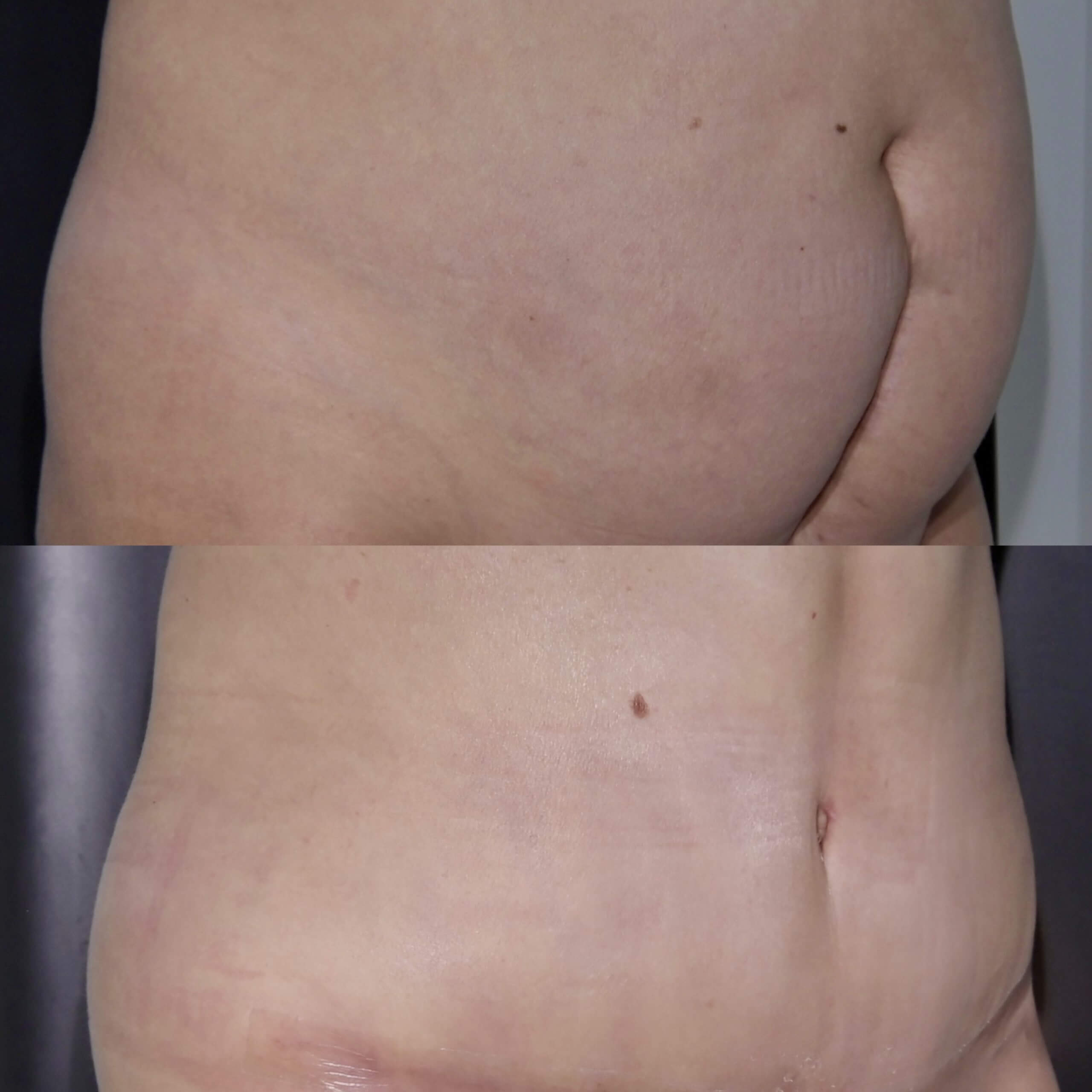 Абдоминопластика с липосакцией 01