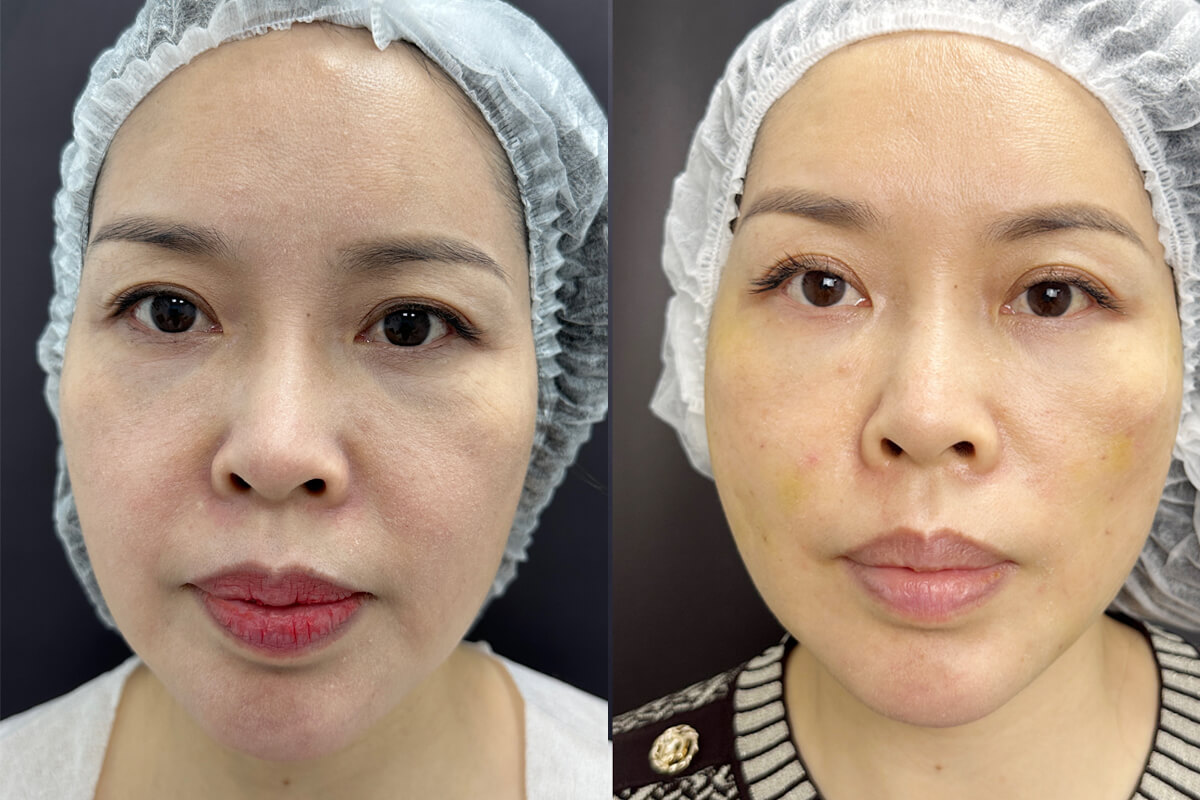 Нитевой лифтинг лица 01