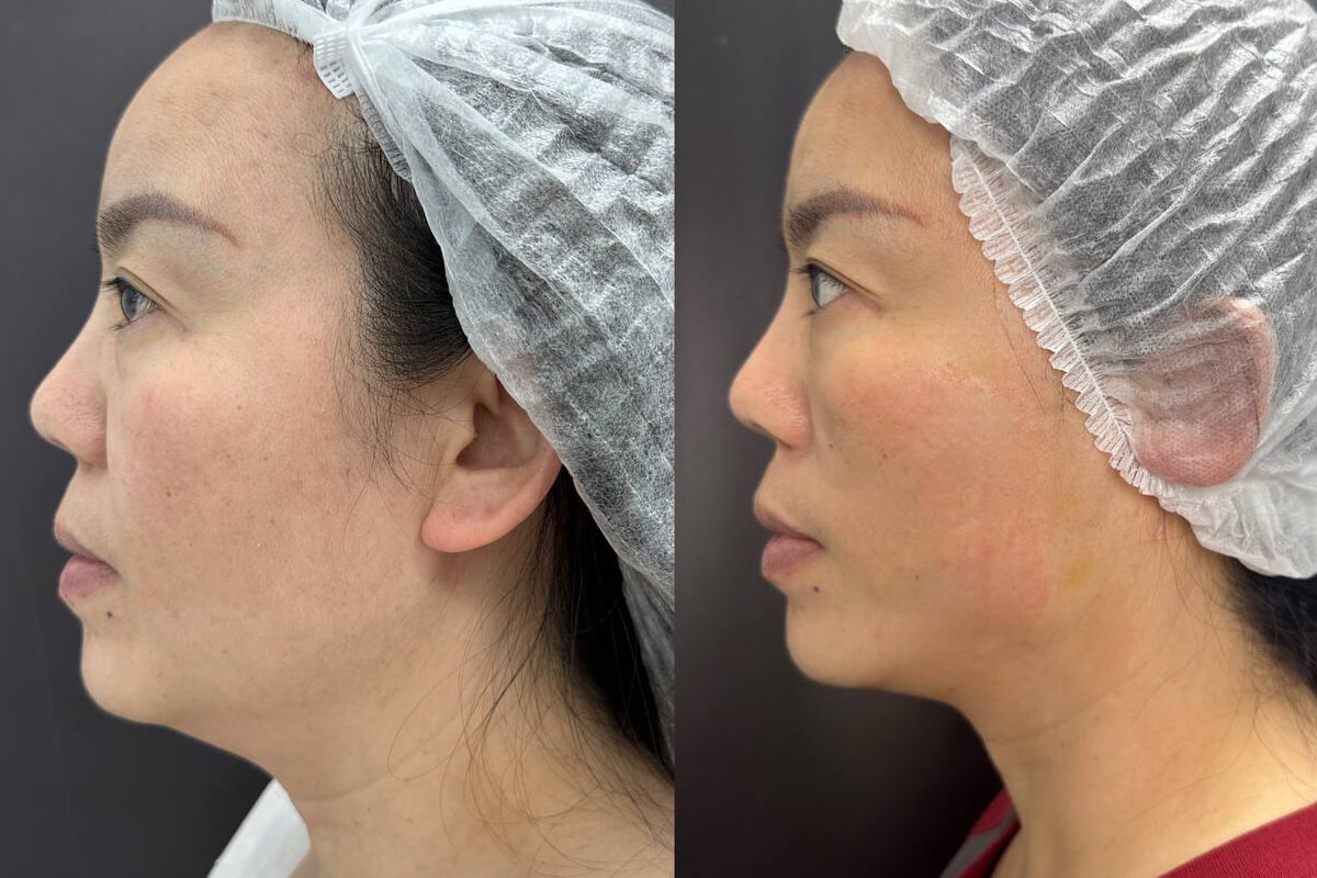 Нитевой лифтинг лица 01