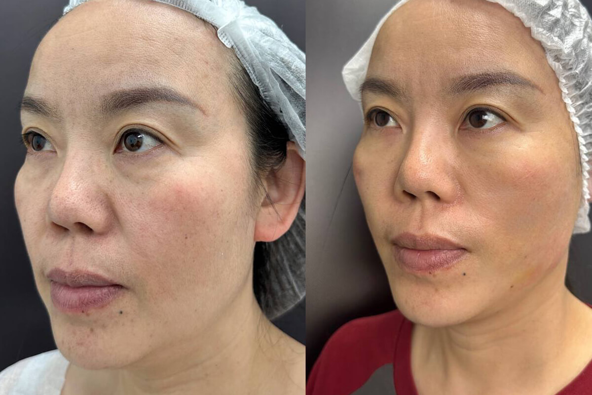 Нитевой лифтинг лица 01