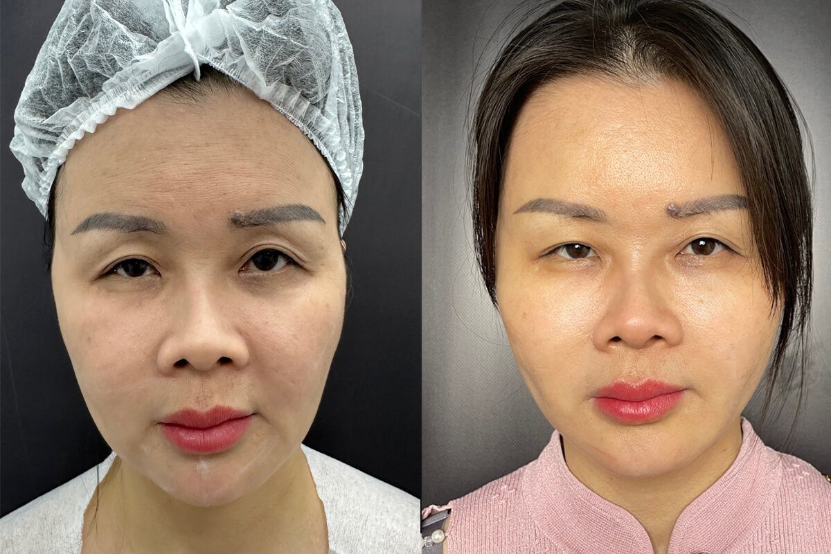 Нитевой лифтинг лица 01