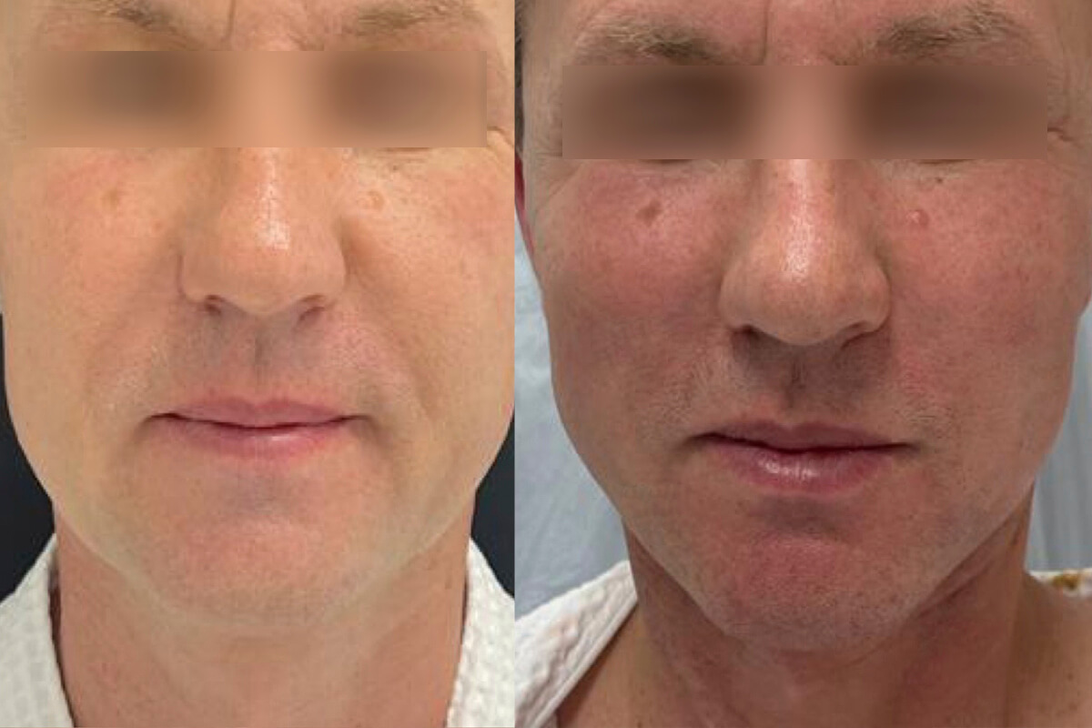 Нитевой лифтинг лица 01