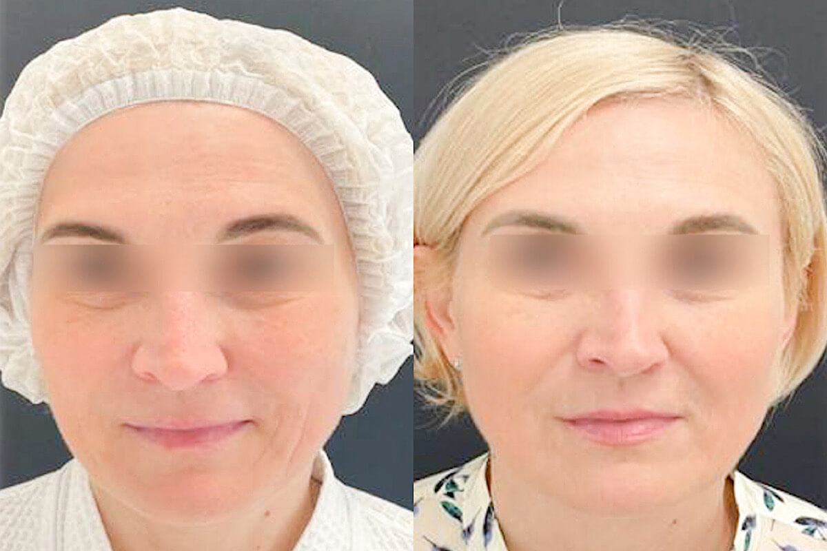 Нитевой лифтинг лица 01