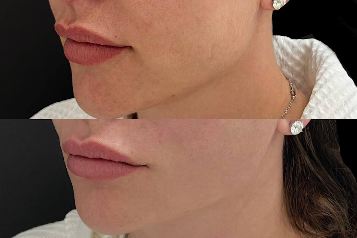 Нитевой лифтинг лица 01