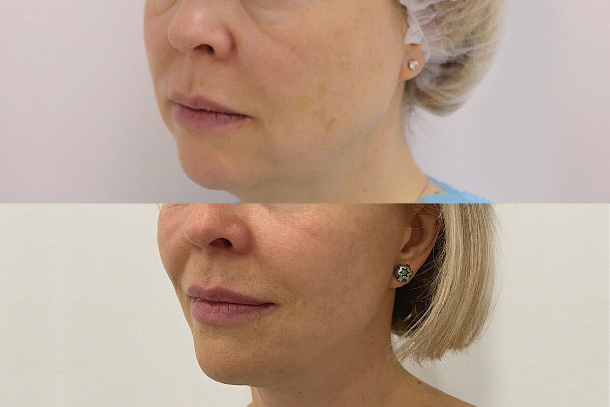 Нитевой лифтинг лица 01