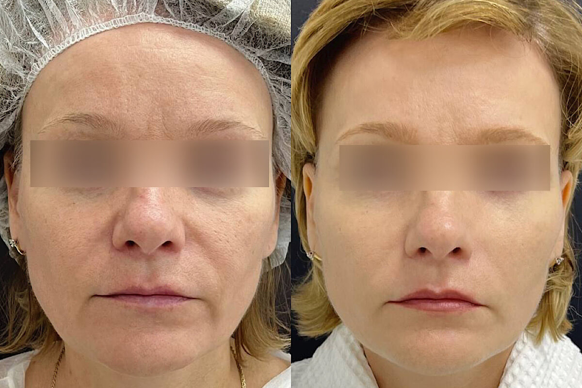 Нитевой лифтинг лица 01