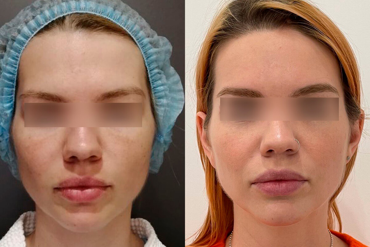 Нитевой лифтинг лица 01