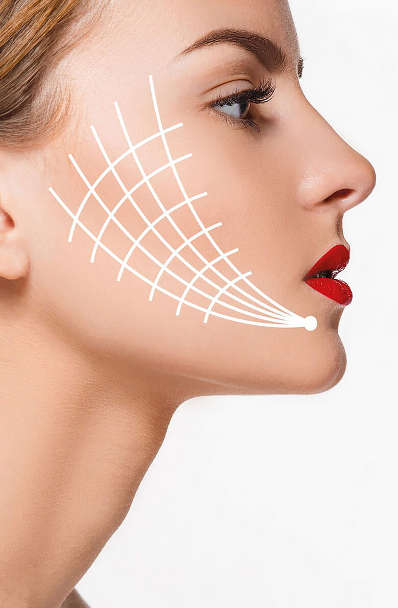 Нитевой лифтинг лица