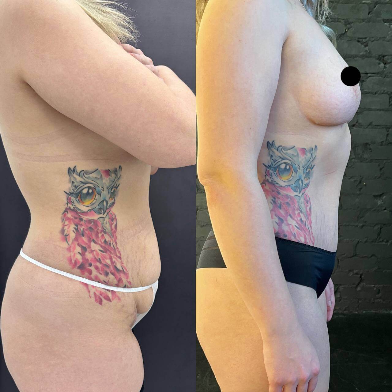 Абдоминопластика с липосакцией 01