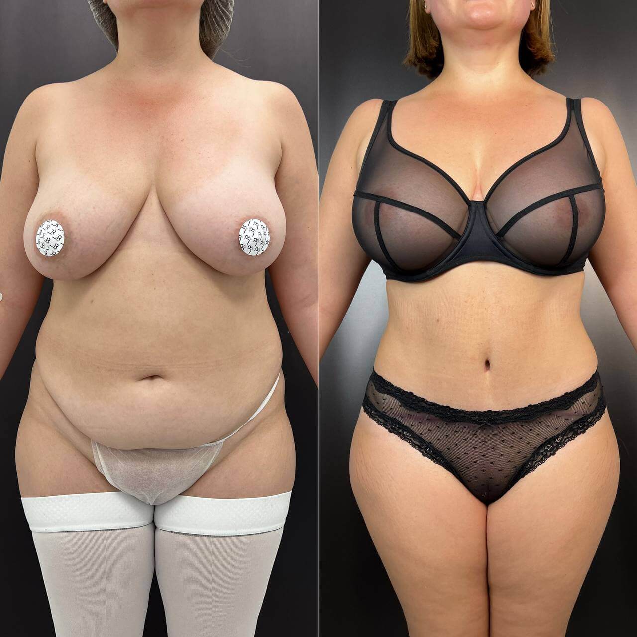 Ушивание диастаза 01