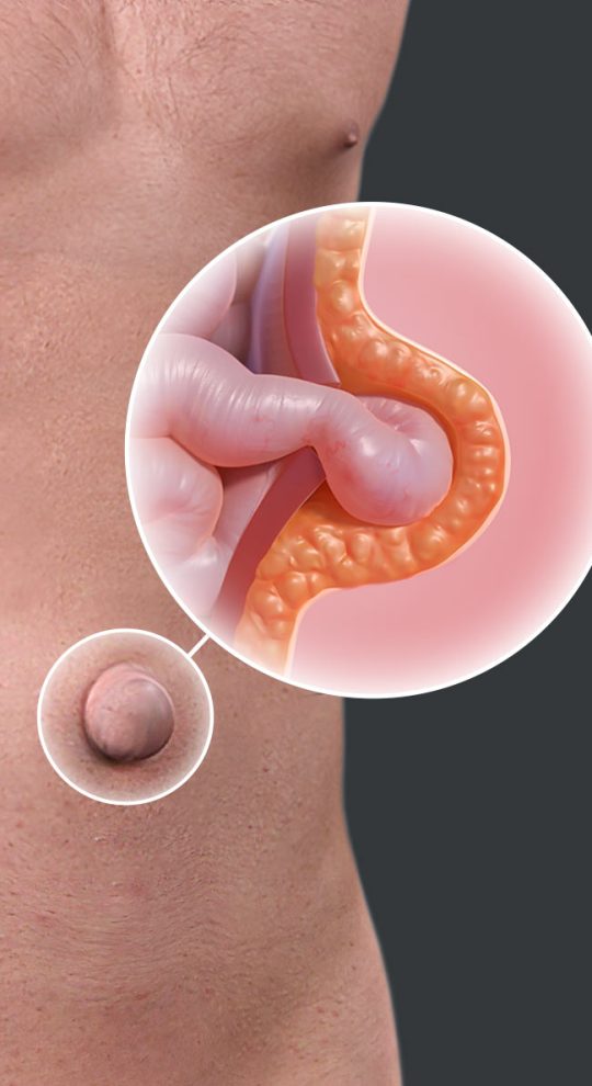 Удаление пупочной грыжи