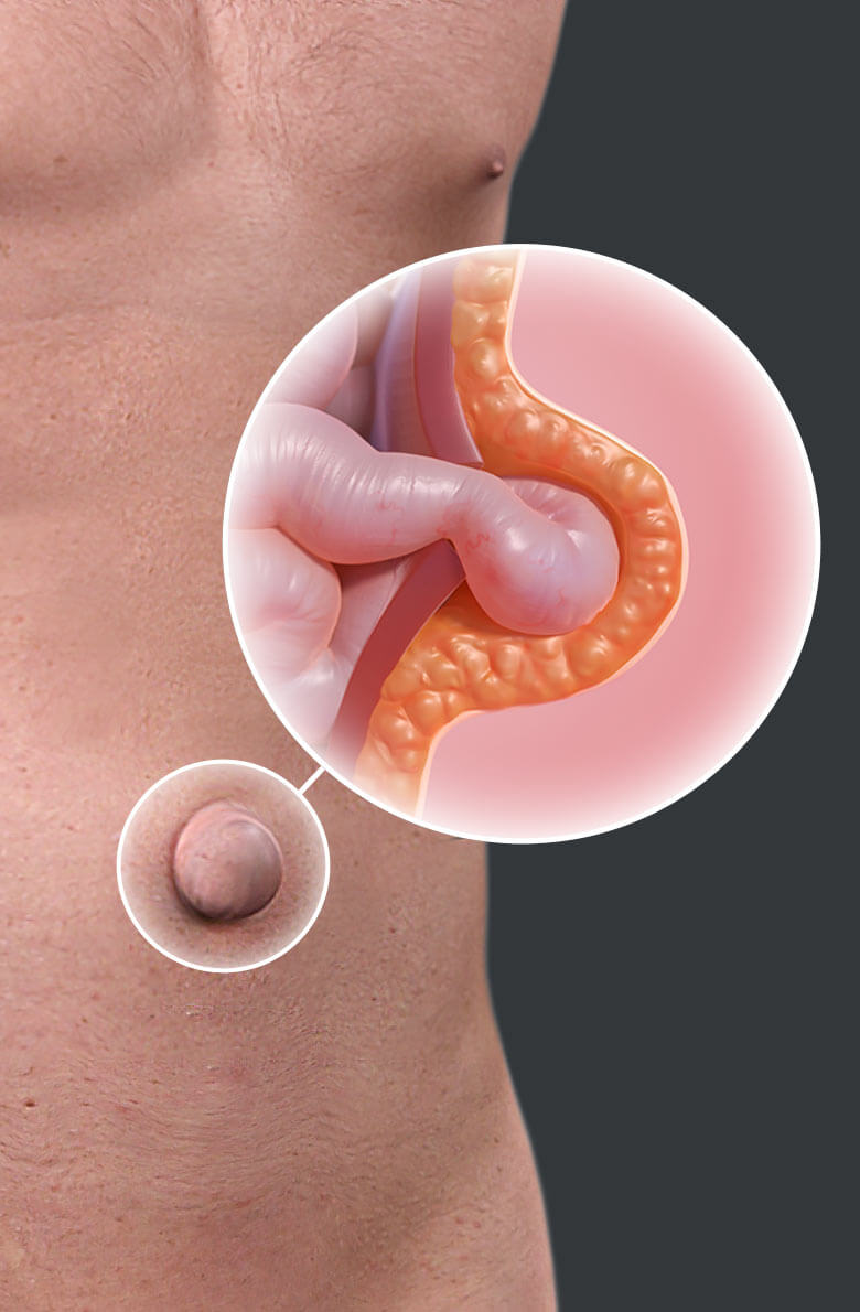 Удаление пупочной грыжи