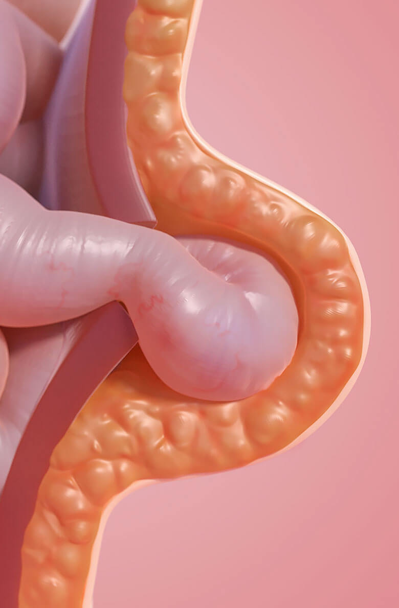 udalenie-pupochnoy-gryzhi-2