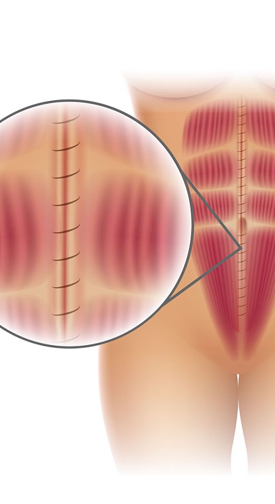 Ушивание диастаза