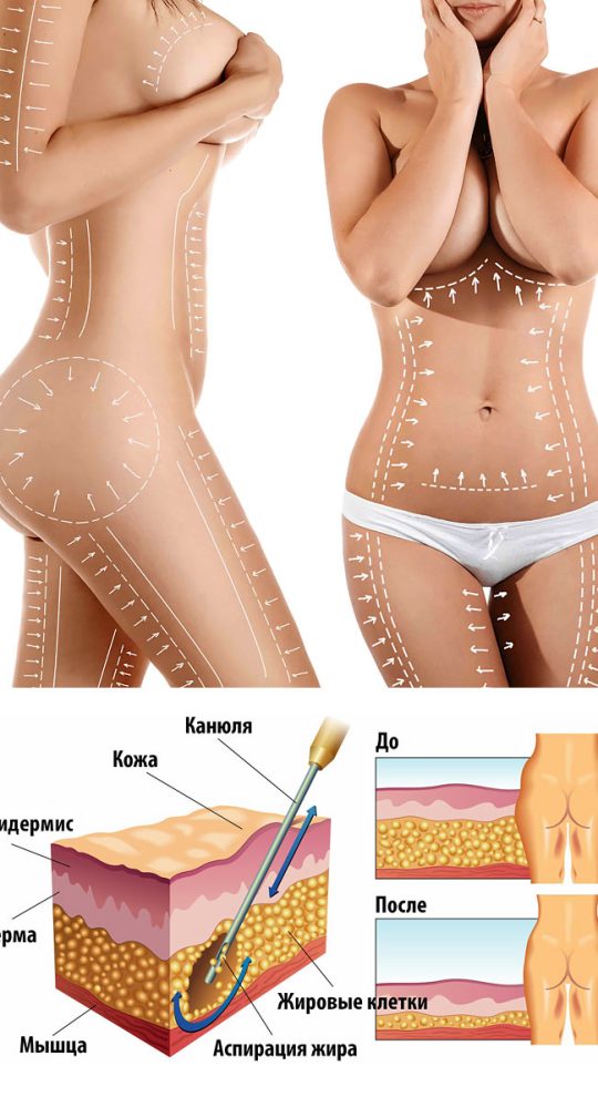 Высокоточная липосакция HD