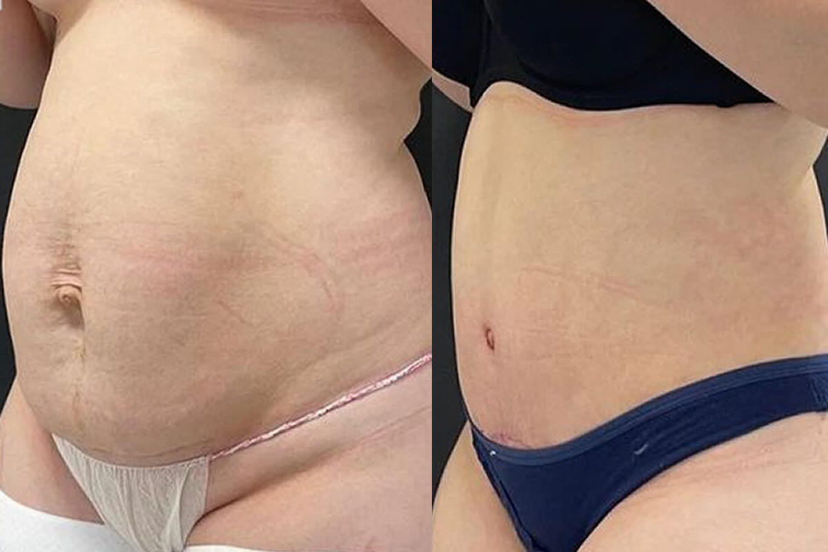 Ушивание диастаза 01