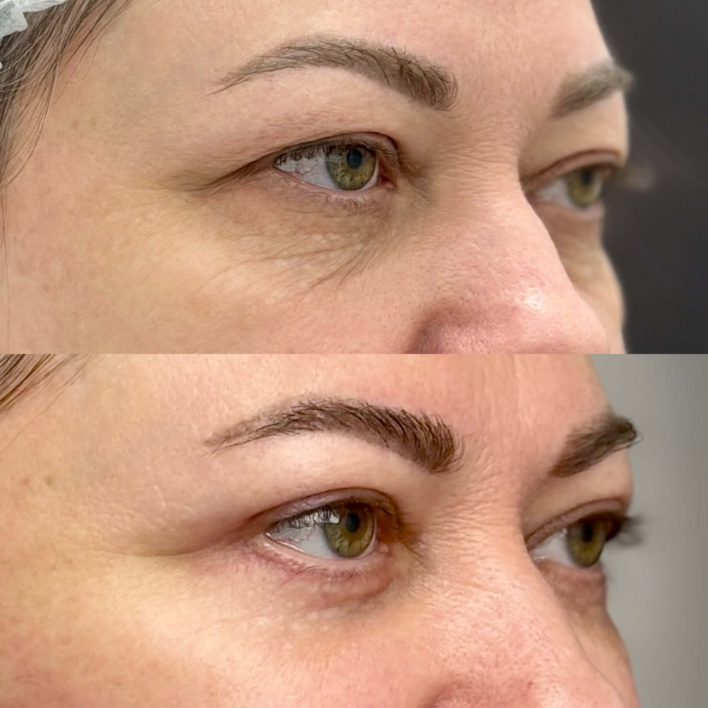 Нижняя блефаропластика 01