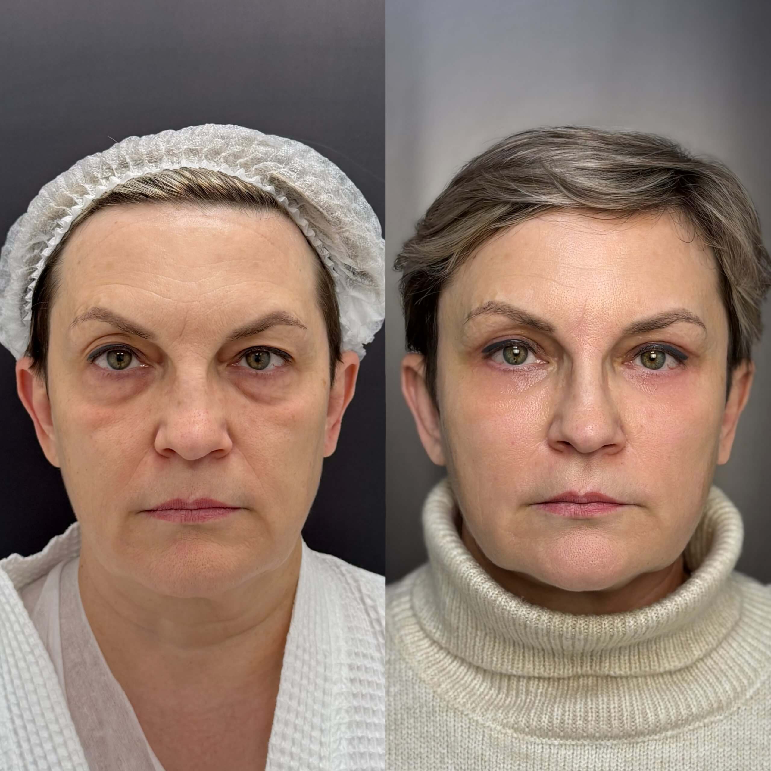 Нижняя блефаропластика 01